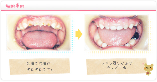 小児歯科施術例